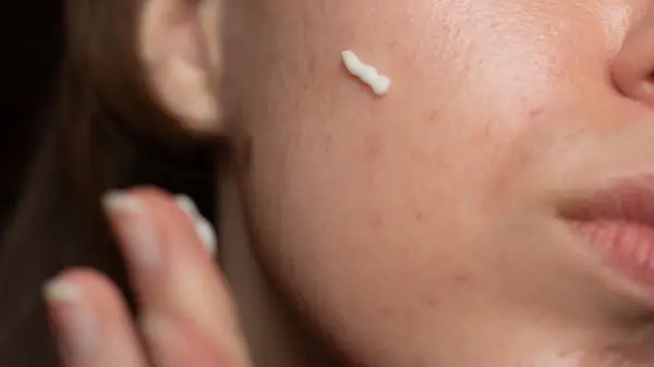 Woman applying cream