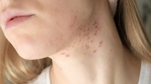 Woman with neck acne