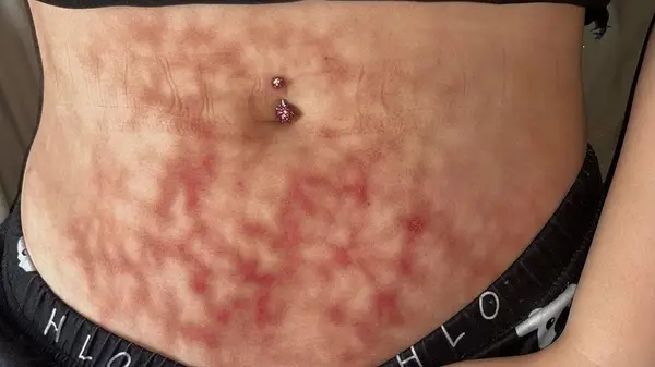 toasted skin syndrome on abdomen