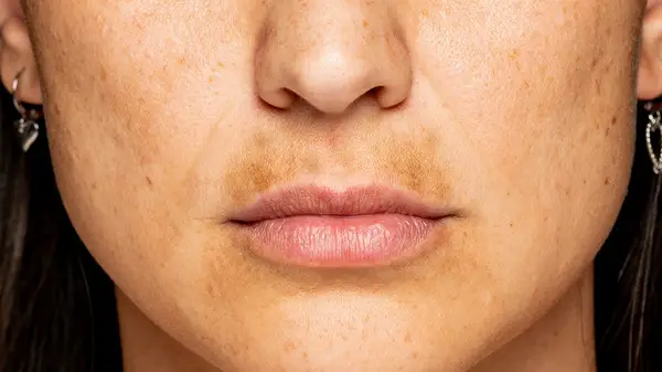 skin discoloration on philtrum