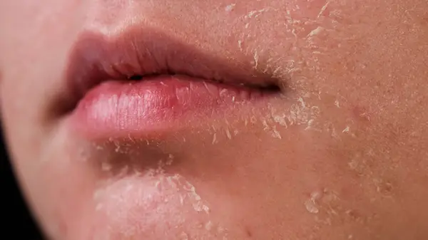 flaky and peeking skin