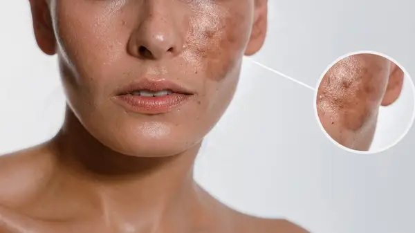 woman with hyperpigmented cheeks