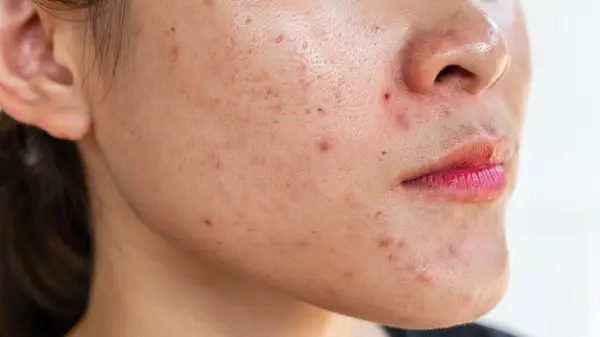 Woman with acne
