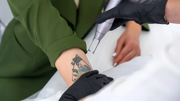 Laser tattoo removal arm black gloves