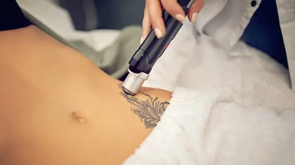 Laser tattoo removal on belly