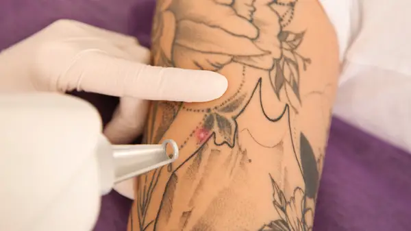 Removing a tattoo white gloves laser