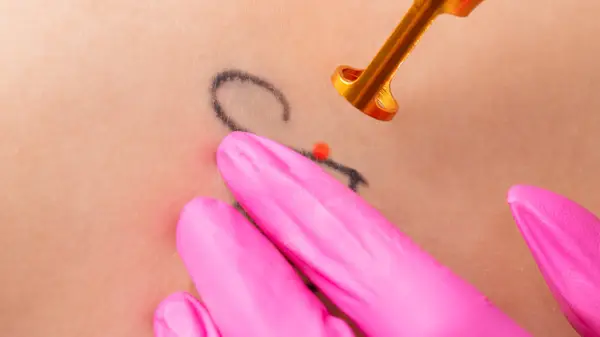 Pink gloved hand removing tattoo