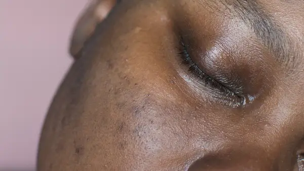 Woman with hyperpigmentation