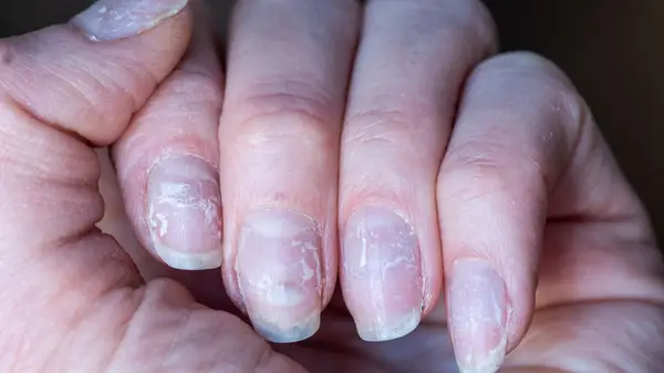 brittle nails