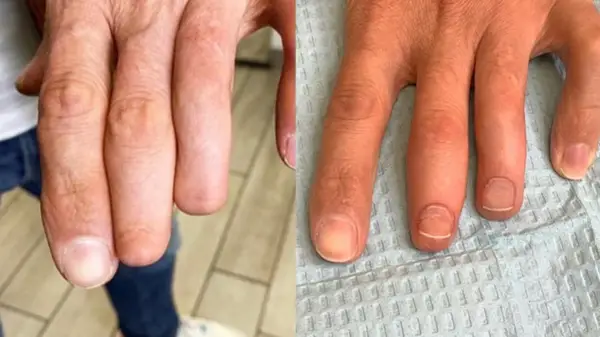 Cosmetic fingernail tattoos over fingers that lost natural nails