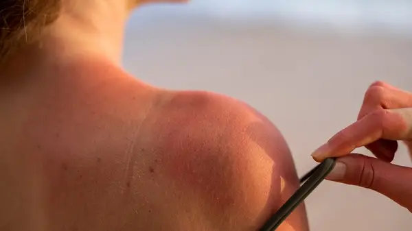 woman with intense sunburn