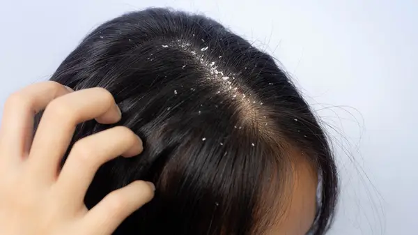 Dandruff problem