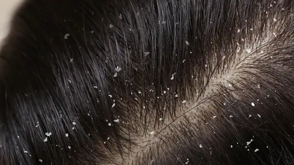 Dandruff close up in hair