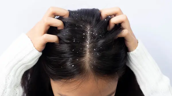Woman with dandruff