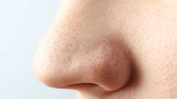 Nose with blackheads