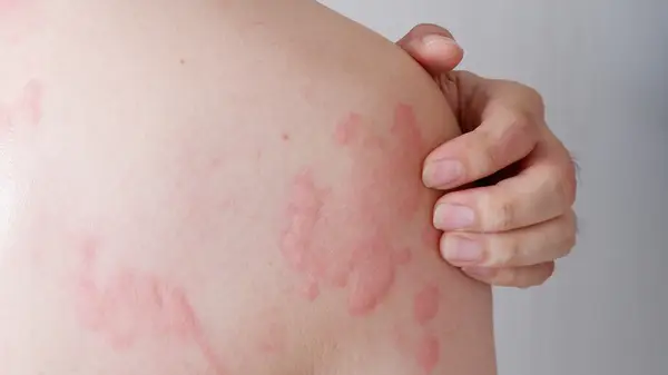 hives on back