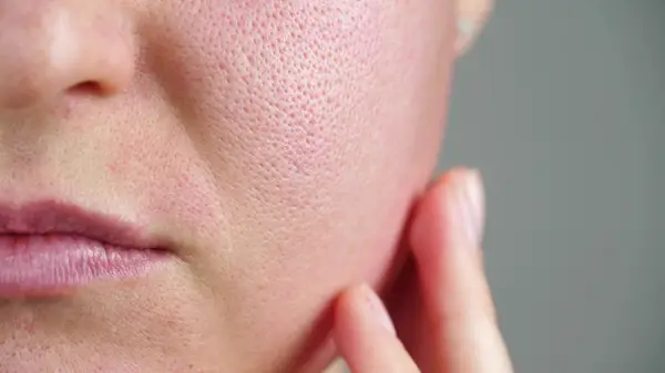 Irritated skin on cheek