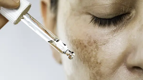 Person applying serum to facial dark spots