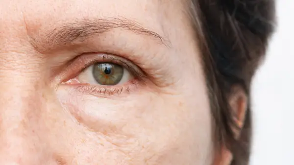 Person with puffy eyes