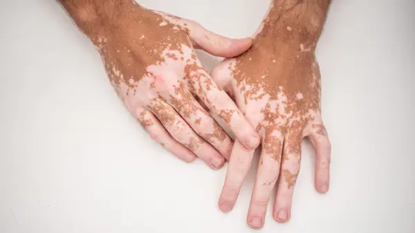 Hands with vitiligo