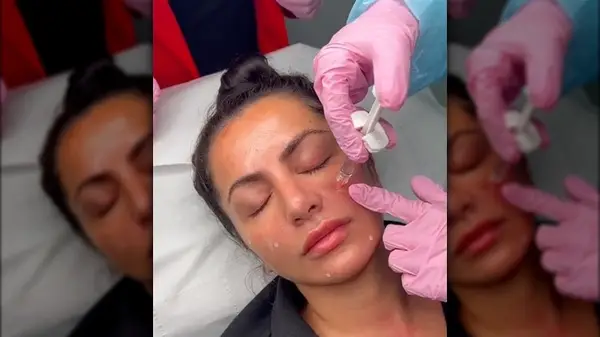 Woman getting Profhilo injections