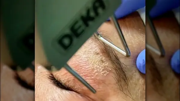 Madonna lift treatment