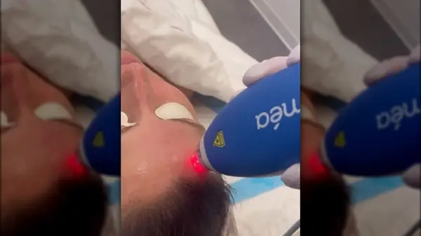 Women getting Clear + Brilliant Touch Laser treatment