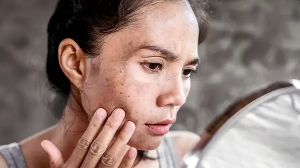 Woman inspecting dark spots on her face in mirror
