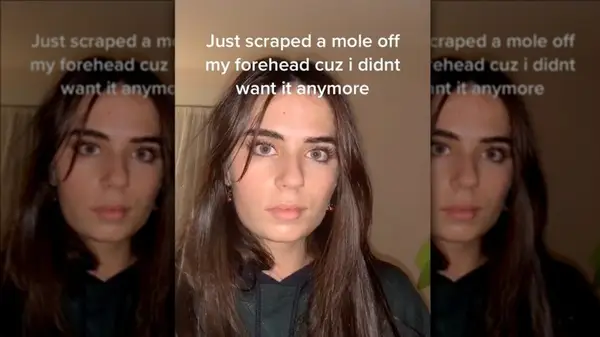 TikToker discussing DIY mole scraping