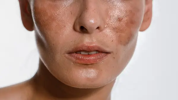 Woman with melasma 