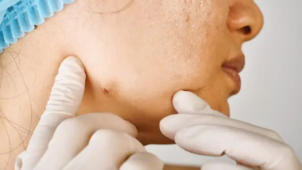 Dermatologist examining cystic acne