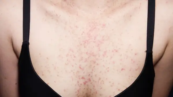 Fungal acne on a woman