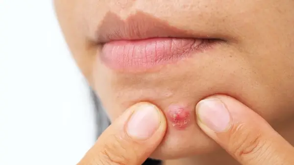 Close up of a pimple on a woman