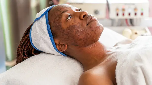 Woman with acne scars