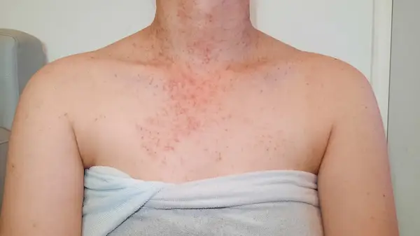 Fungal acne on a woman