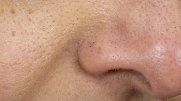 Nose sebaceous filaments