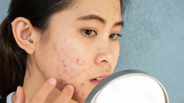 Woman looking at acne in mirror