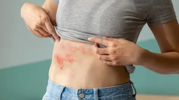 Woman with stomach rash