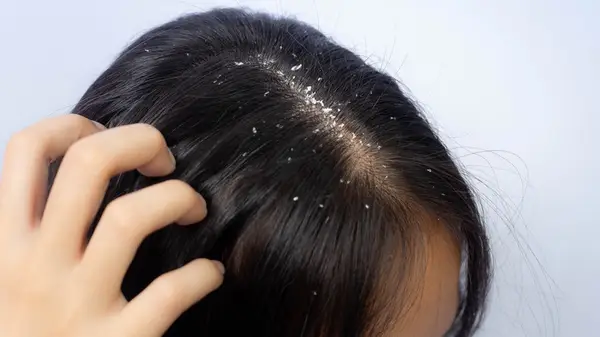 Person with dandruff