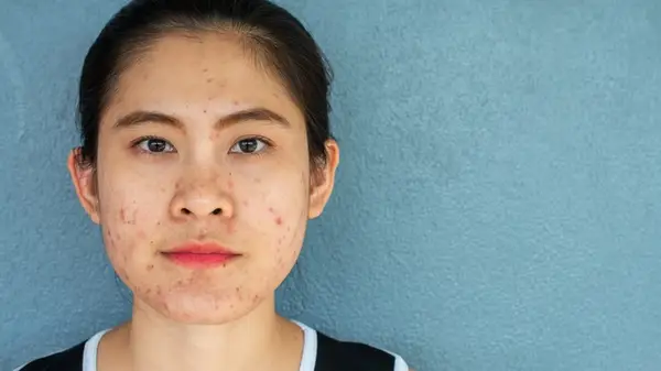 portrait model has acne