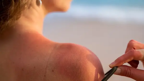woman with sunburn 