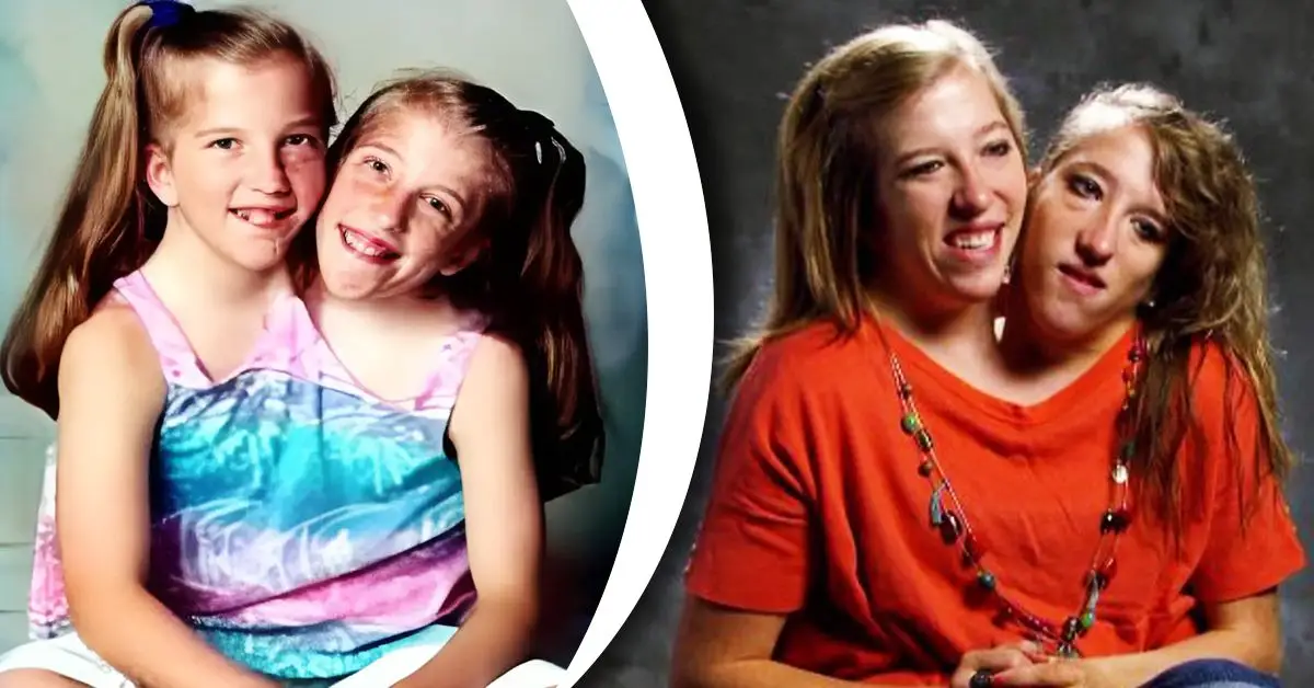 TLC Stars Conjoined Twins Abby og Brittany Hensel Now