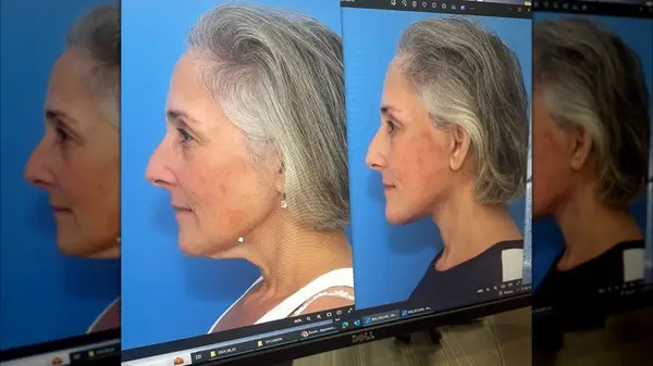 Ricki Lake shared photos of her before and after face lift procedure