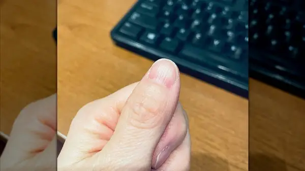A ridged thumbnail