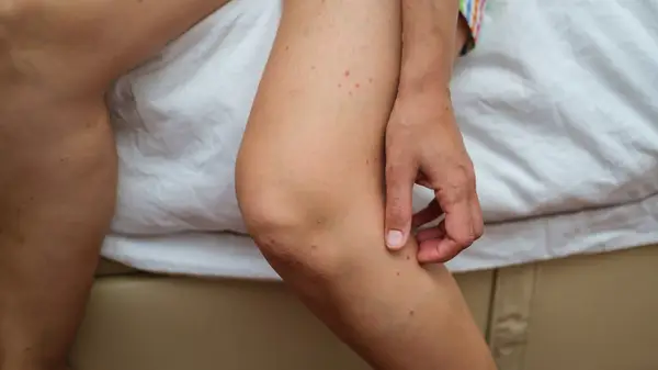 Woman scratching leg